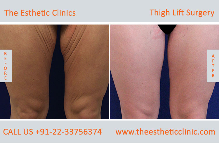 Thigh Lift Surgery, Thigh Reduction before after photos in mumbai india (3)